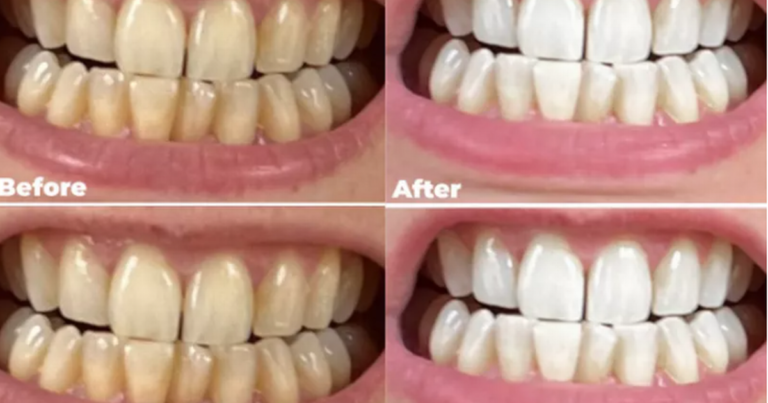 Beauty shoppers ‘bottle’ a £25 dentist-approved solution teeth whitening powder that claims to be ‘painless’ and ‘8 times whiter’